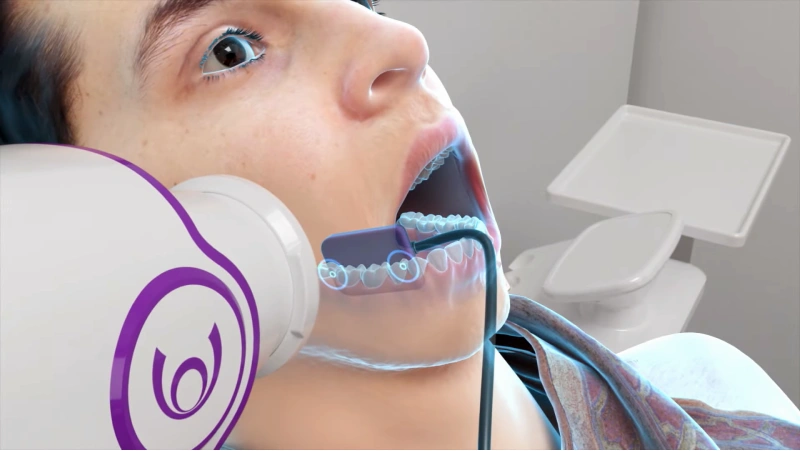Woson Rayin IntraOral X-Ray Sensors Inside Mouth